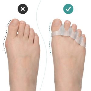Alternative view of OrthoRelax® – Gélový oddeľovač prstov (2 oddeľovače)
