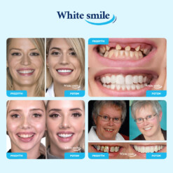 Alternative view of WHITESMILE™ – Nastaviteľná Kozmetická Zubná Fazeta