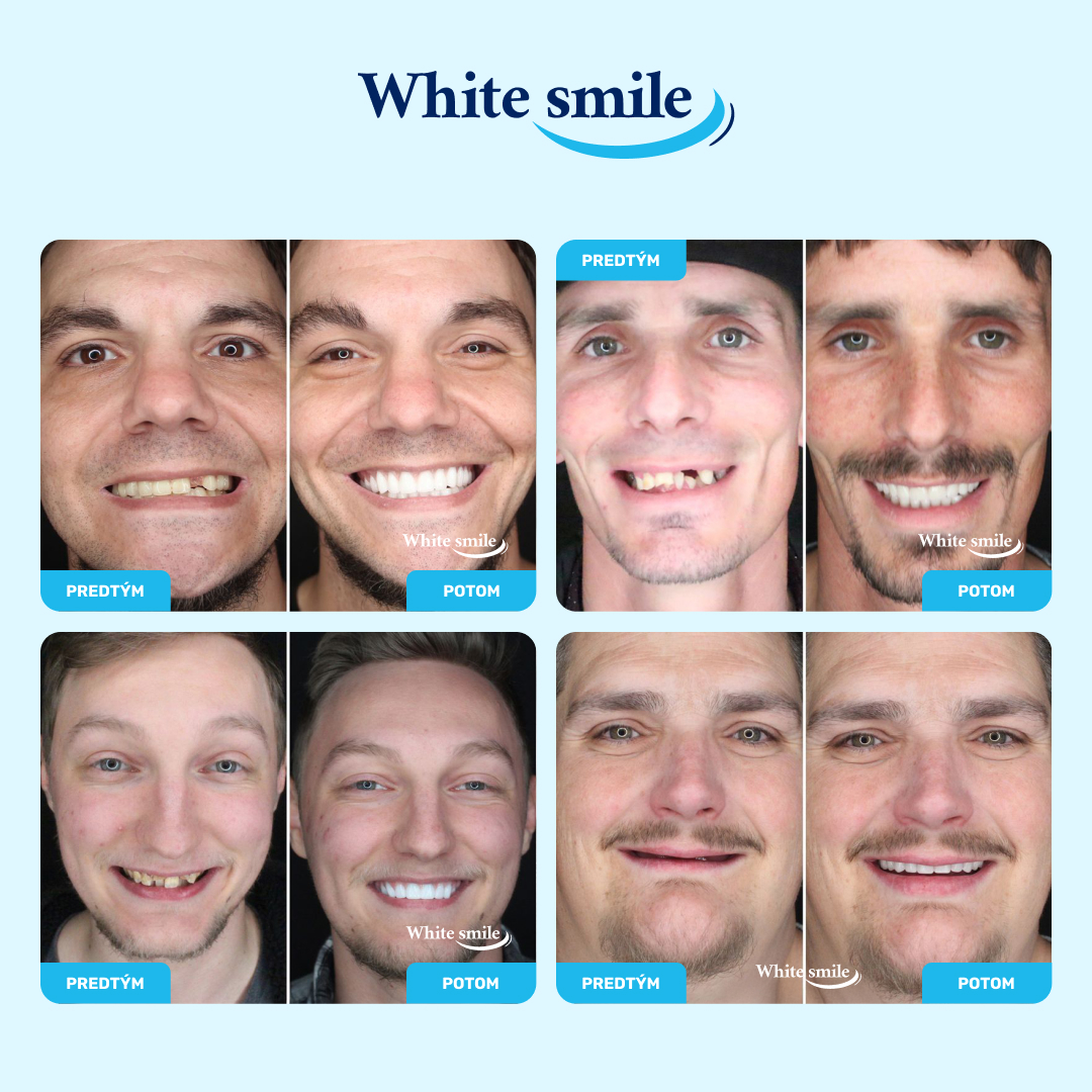 WHITESMILE™ – Nastaviteľná Kozmetická Zubná Fazeta – Obrázok 3