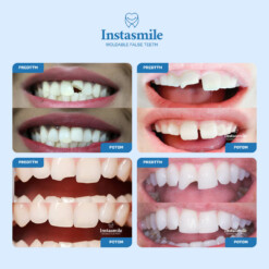 Alternative view of INSTASMILE REPARAČNÝ KIT NA ZUBY